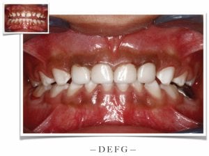Small before and large after of teeth with White Crowns
