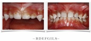 a before and after of teeth with White Crowns