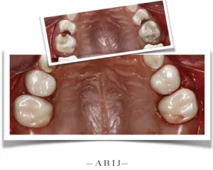 A small before and a large after of teeth with white crowns