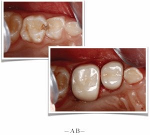 A small before and a large after of teeth with white crowns